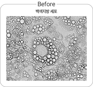 Before 백색지방