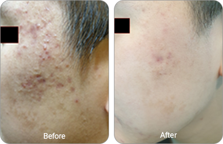 1회 3개월간격 전후사진